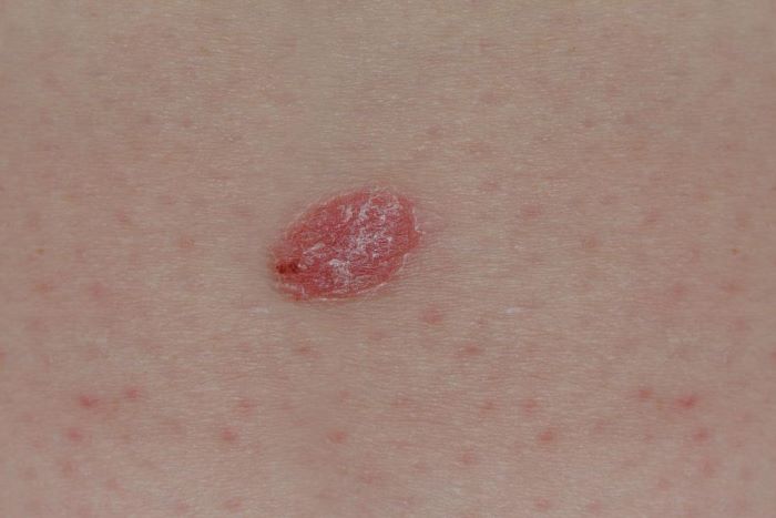 Saiba aqui quais as características do câncer de pele e como tratar