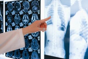 A tuberculose, também conhecida como "tisica pulmonar", é uma doença infectocontagiosa muito antiga