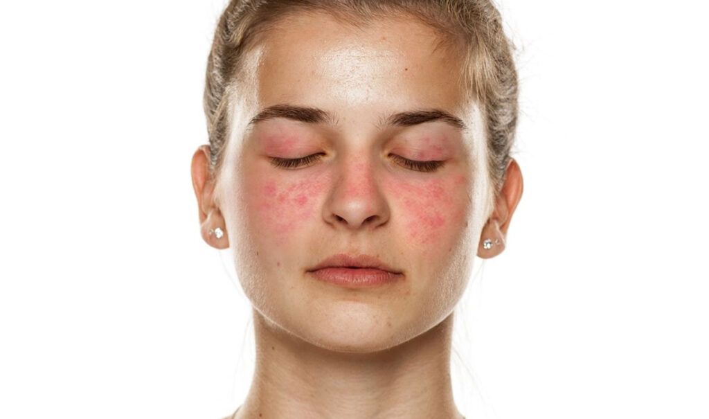 Fevereiro Roxo: lúpus e fibromialgia, entenda os sinais